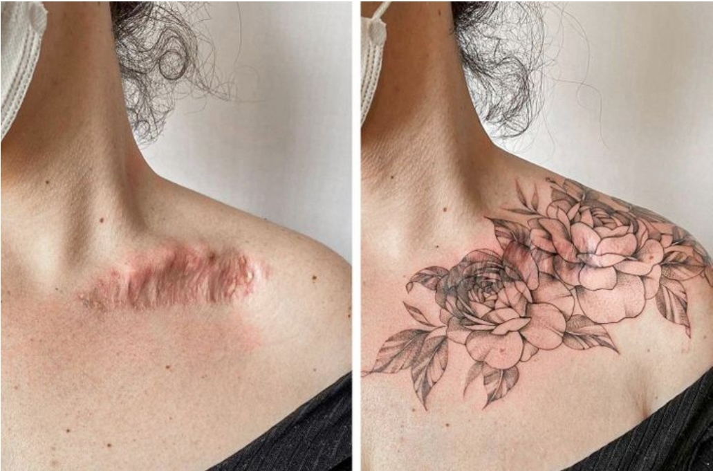 15+ Stunning Scar Cover-Up Tattoos That Turn Scars Into Art